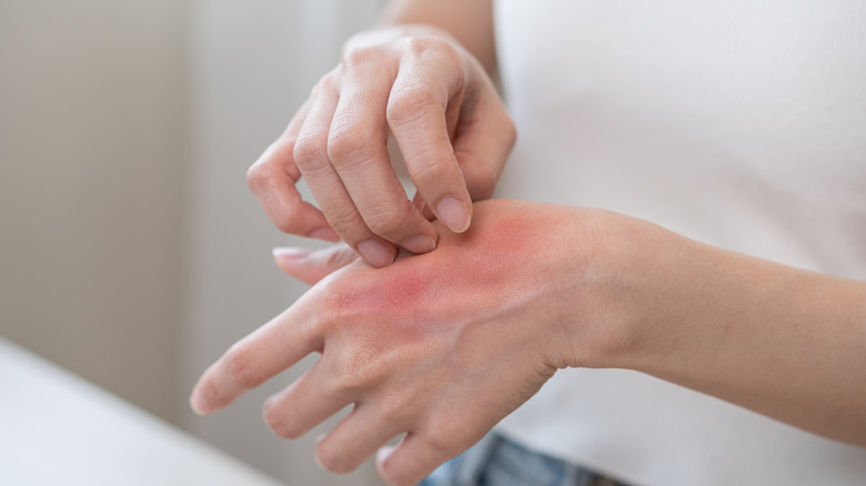Young woman experiencing a rash on her hand
